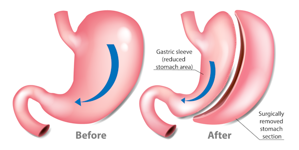 Gastric Sleeve - Tijuana, Mexico - Vision Bariatrics - Surgery