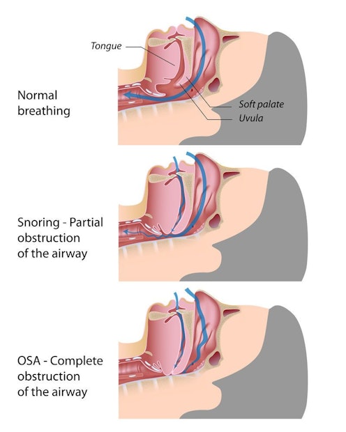 Diagram showing position of tongue, soft palate, and uvula with normal breathing, snoring with partial obstruction of the airway, and OSA with complete obstruction of the airway