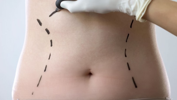 Surgical marks being made on woman's stomach