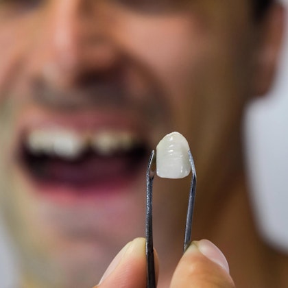 Holding up broken crown in front of man with broken tooth