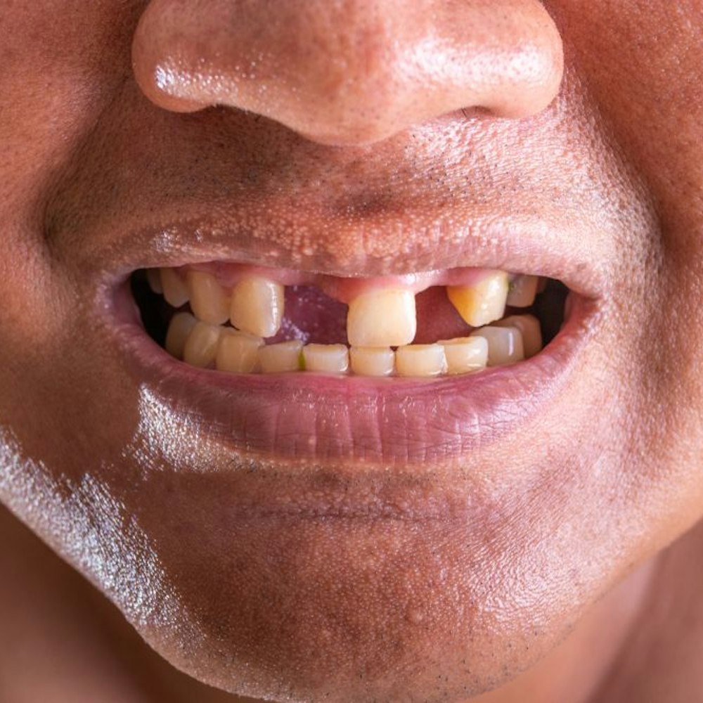 Person with missing teeth