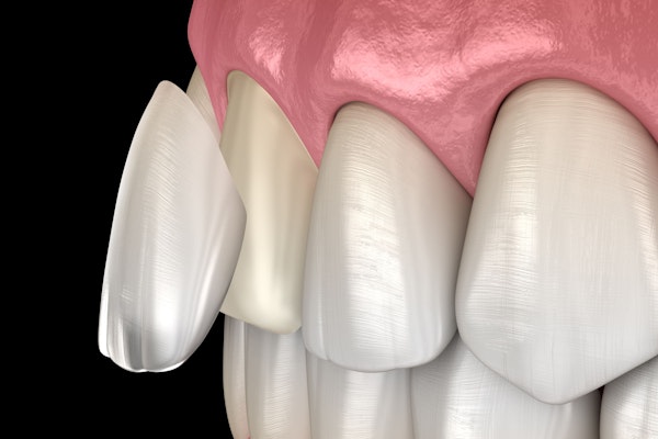 veneer diagram