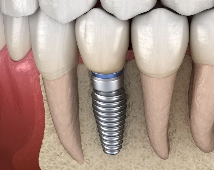 dental implant