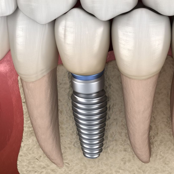 dental implant