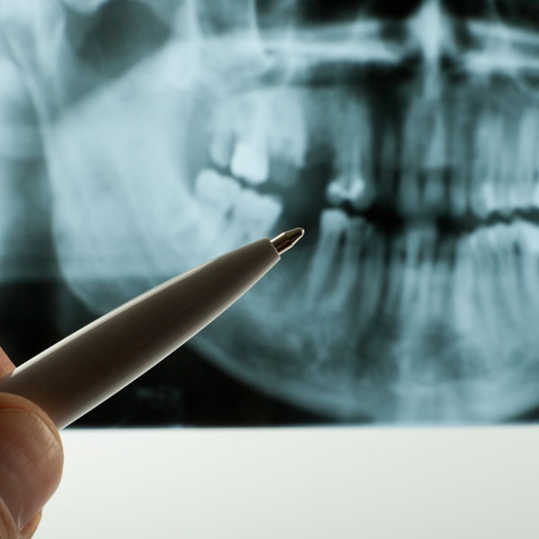 Dentist pointing at a x-ray of root canal