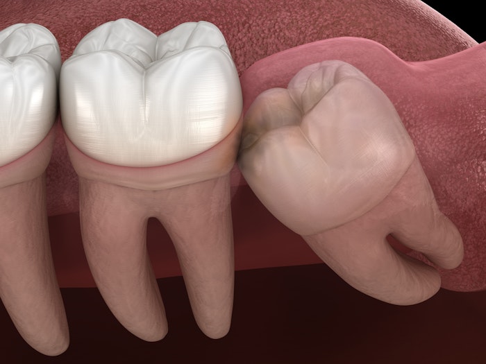 Impacted wisdom tooth