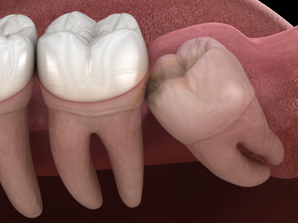 Illustration of an impacted wisdom tooth