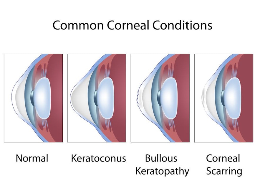 corneal diseases