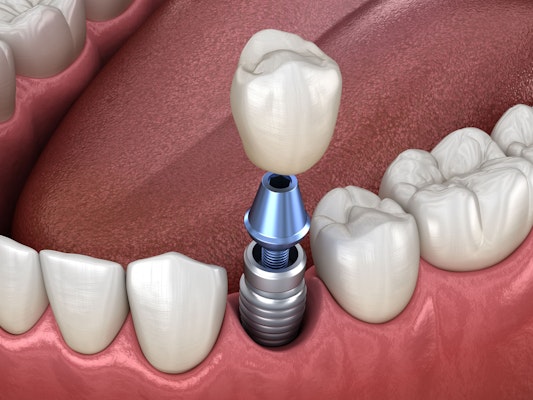 Dental crown implant