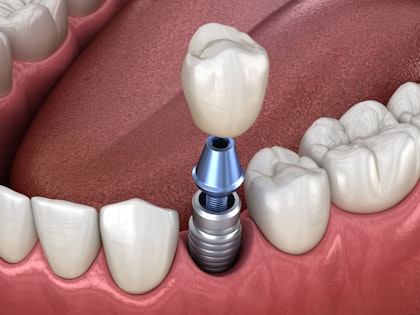 Dental Implants