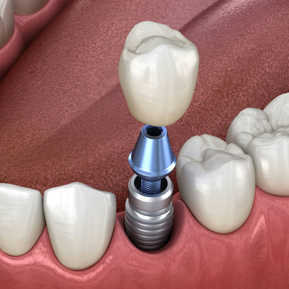 Dental implant