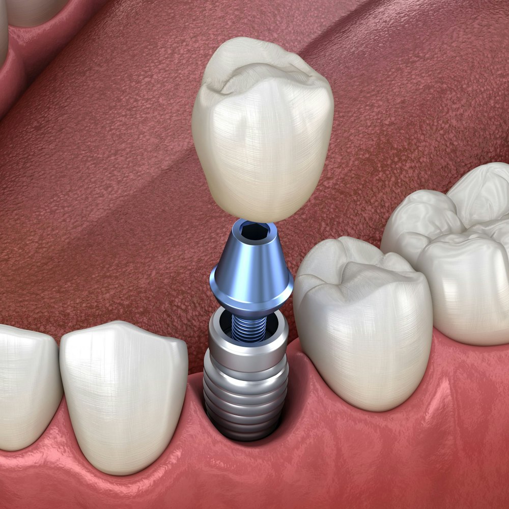 Dental Implant
