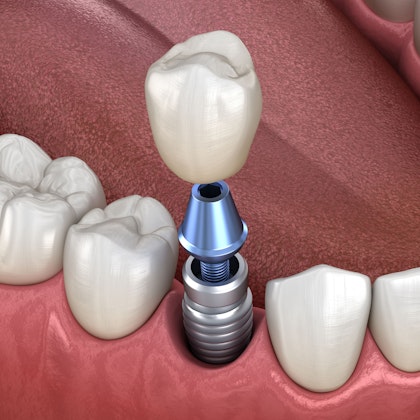 implant-supported dental crown