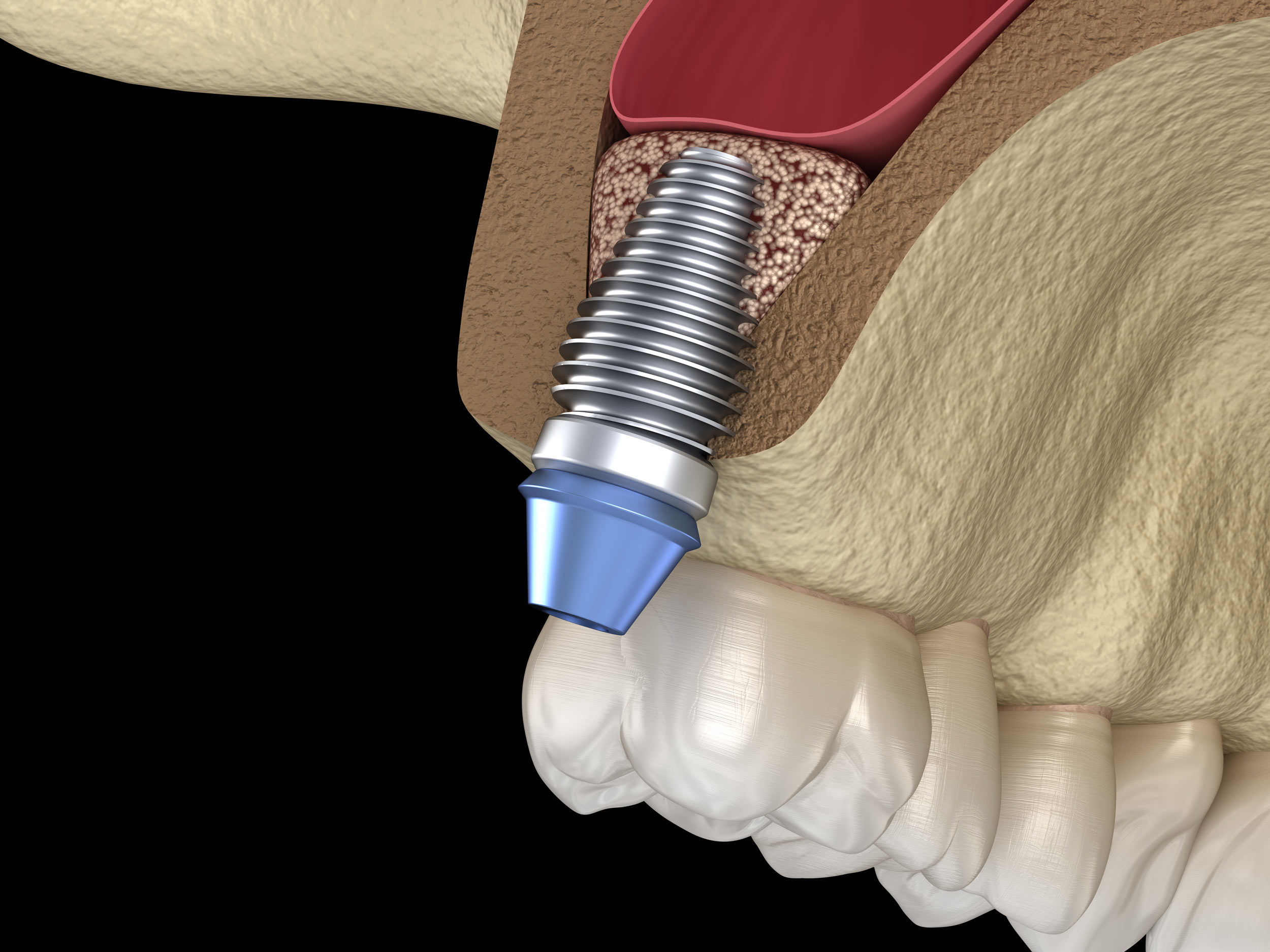 implant being placed in upper jaw after grafting
