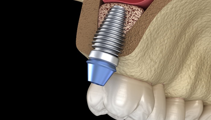 implant being placed in upper jaw after grafting
