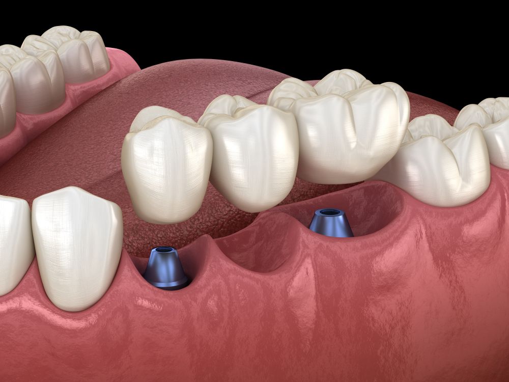 What are the benefits and types of undergoing temporary tooth bridges?