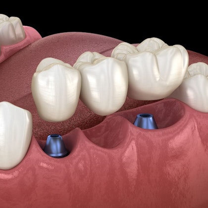 Implant-Supported Bridge