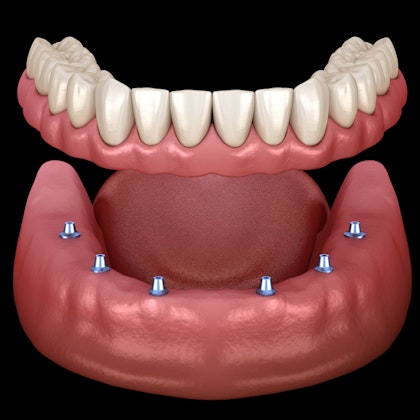 implant-supported denture