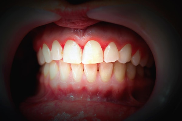 gums with gingivitis