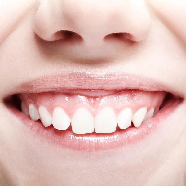 gummy smile