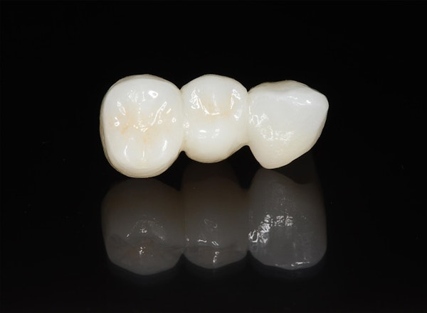 Lifelike dental bridge