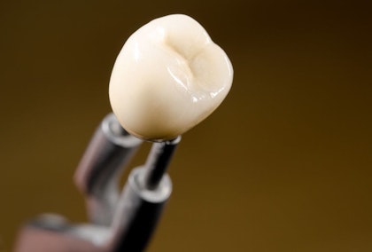 image of dental implant crown with tweezers