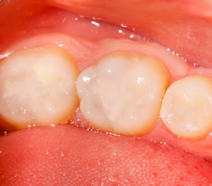 dental filling