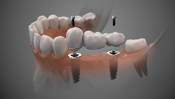 An implant-supported bridge