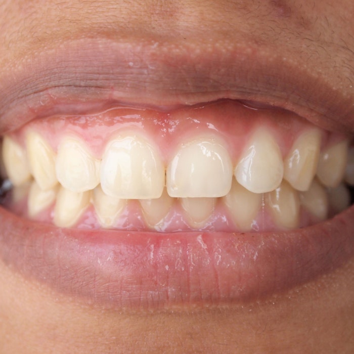 illustration showing a gum contouring before and after