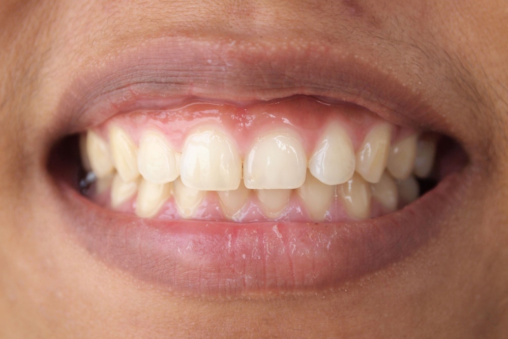 Gum Contouring Merritt Island, FL - Family Dentistry & Prosthodontics