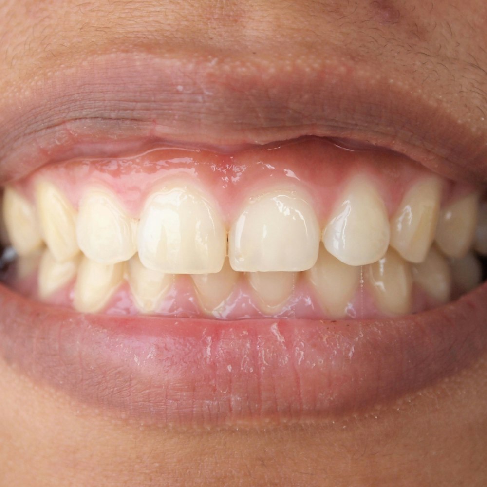 Gummy smile
