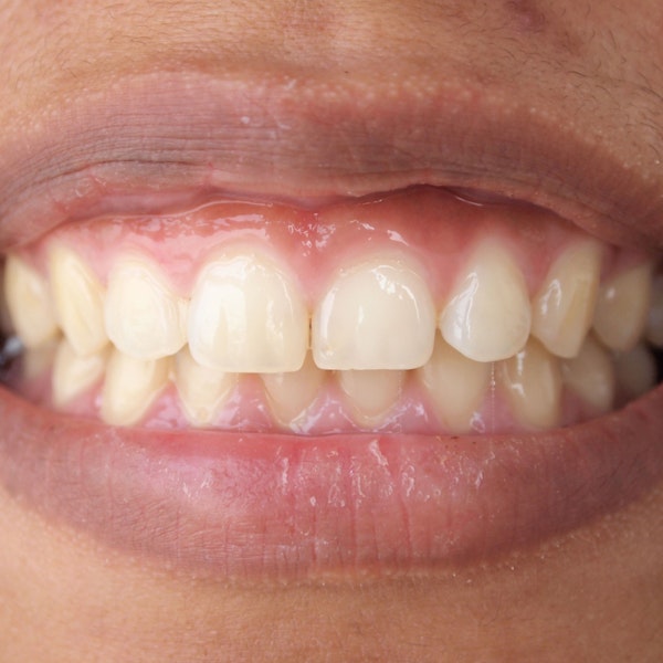 A patient with a gummy smile