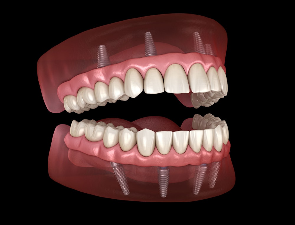 Implant-Supported Dentures