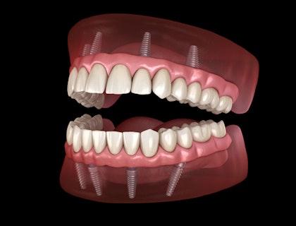 Dental implants