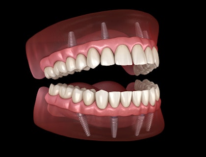 Implant-supported dentures
