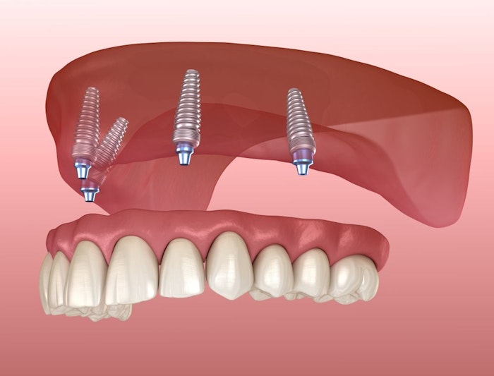 Implant-supported denture