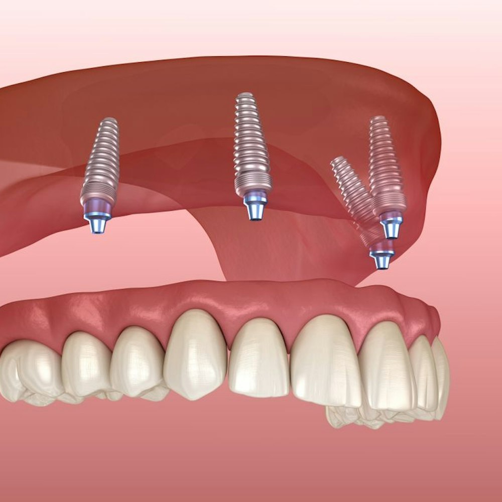 All-on-4 Implants