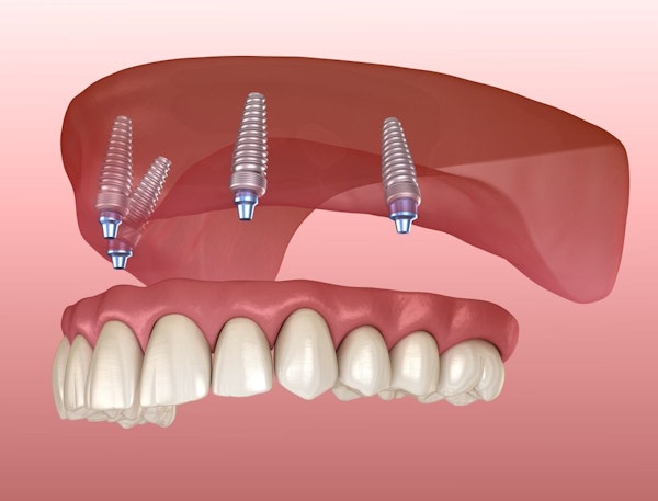 Illustration of All-on-4 implants