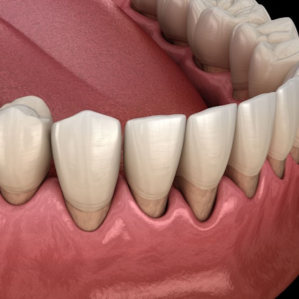 unhealthy receded gums