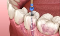 Drilling into an infected tooth