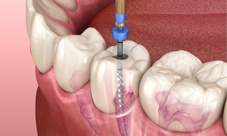 Illustration of root canal procedure