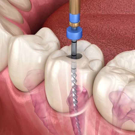 Illustration of root canal procedure