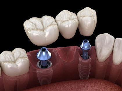 An illustration of an implant-retained dental bridge