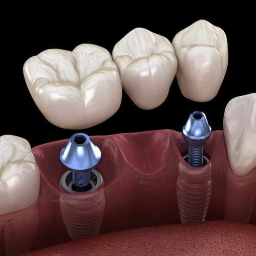 An illustration of an implant-supported bridge