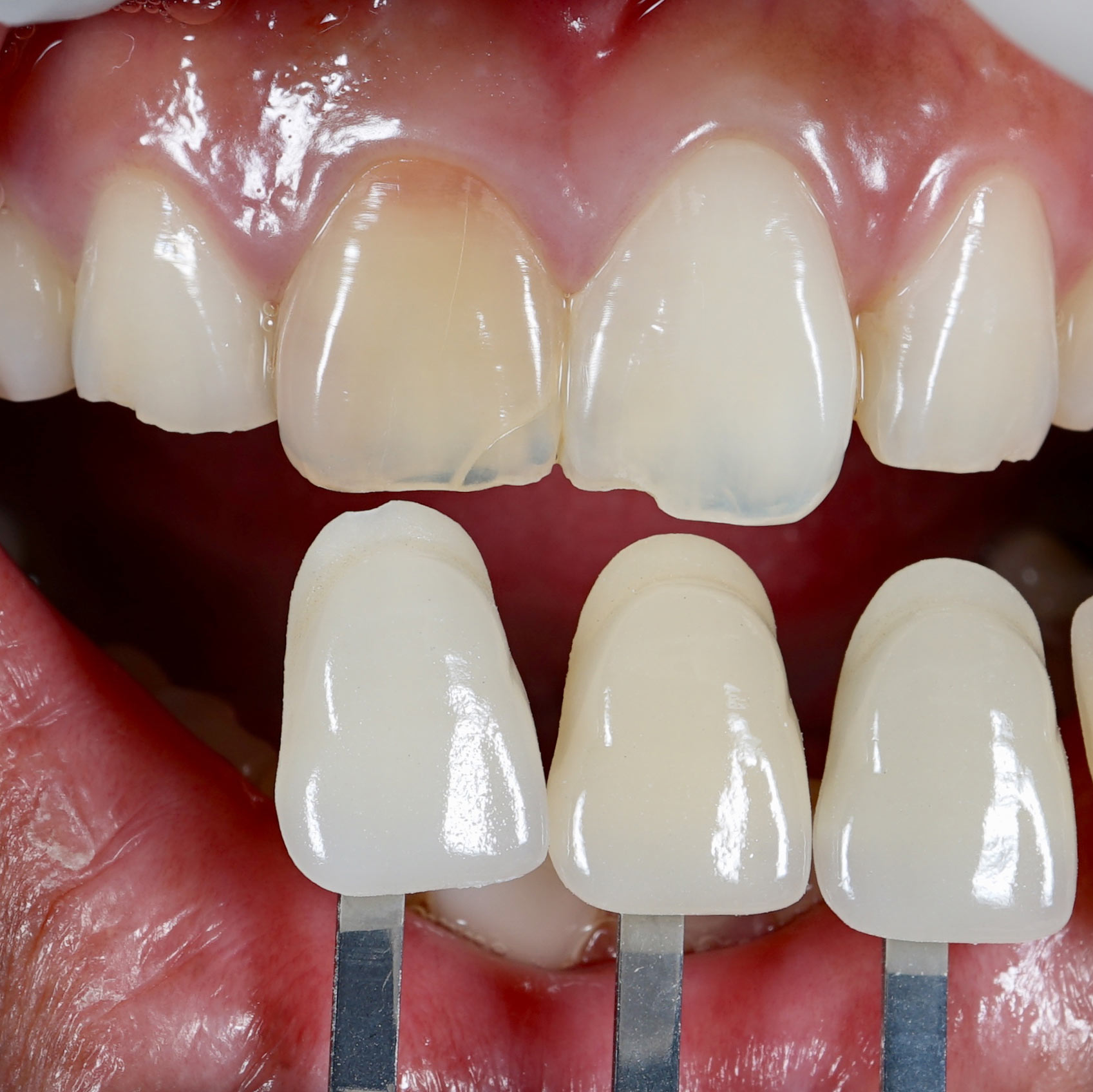 veneers in different shades tested against a man's smile
