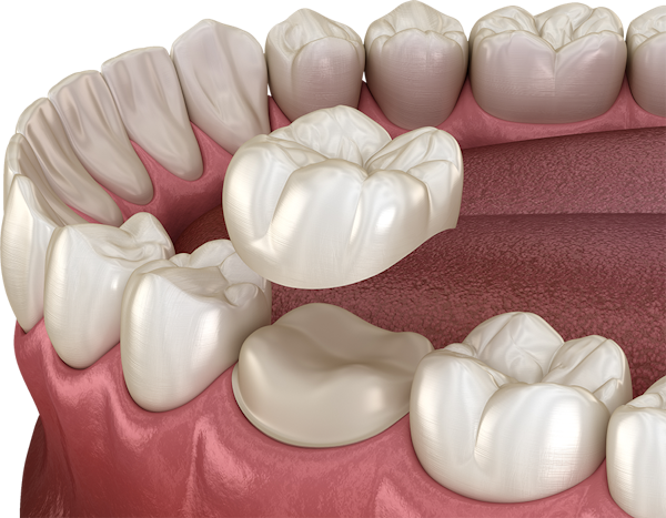 illustration of support tooth with crown about to be placed