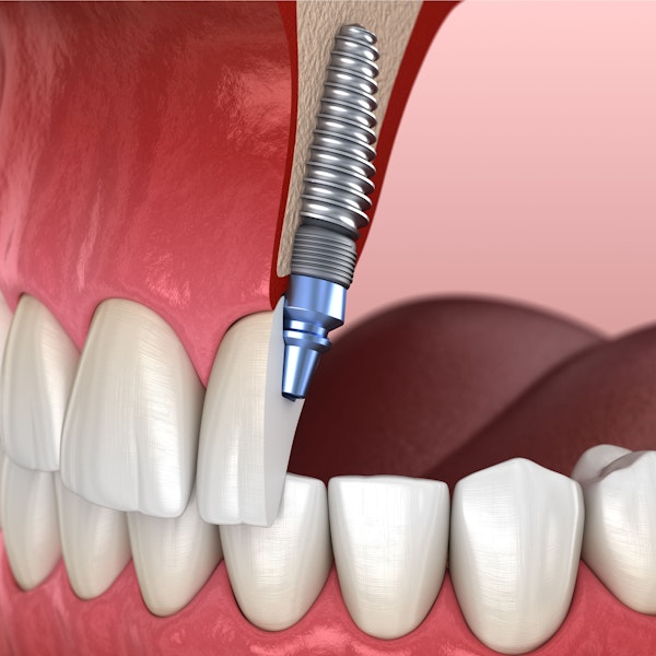 Illustration of dental implant