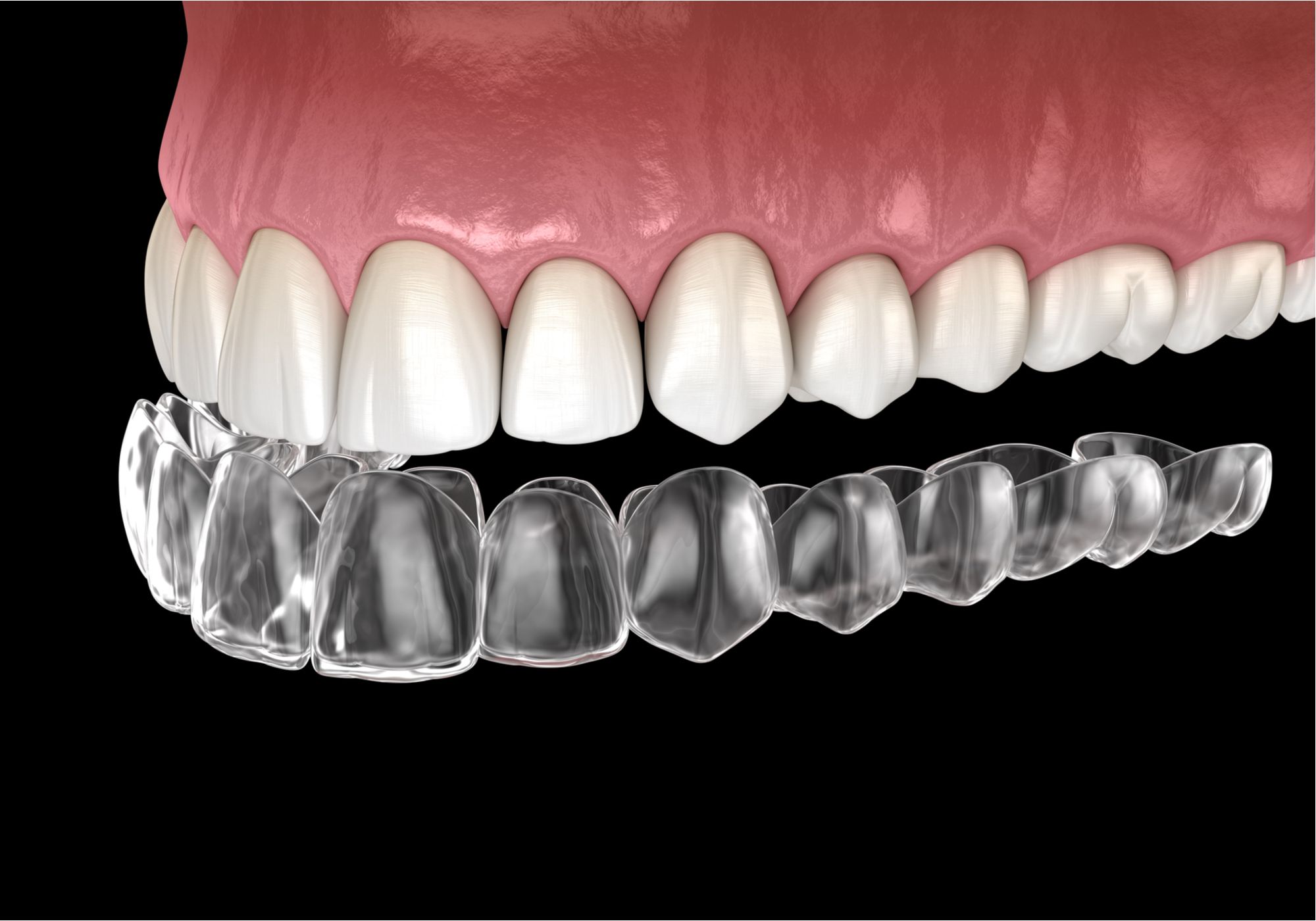Clear Aligners over teeth