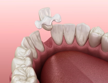 An illustration of a Maryland dental bridge