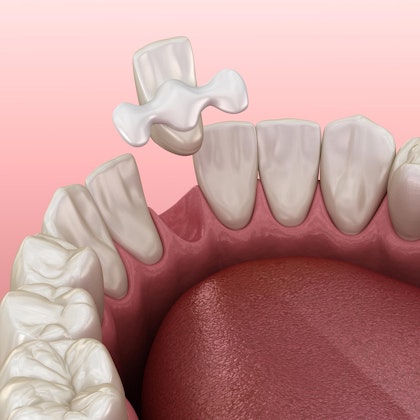 An illustration of a Maryland dental bridge
